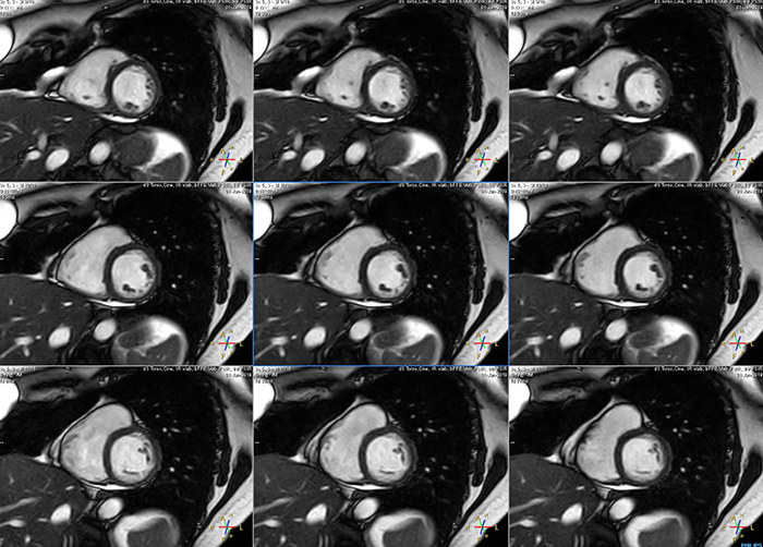 MCVI Ambition Short breath hold cardiac cine